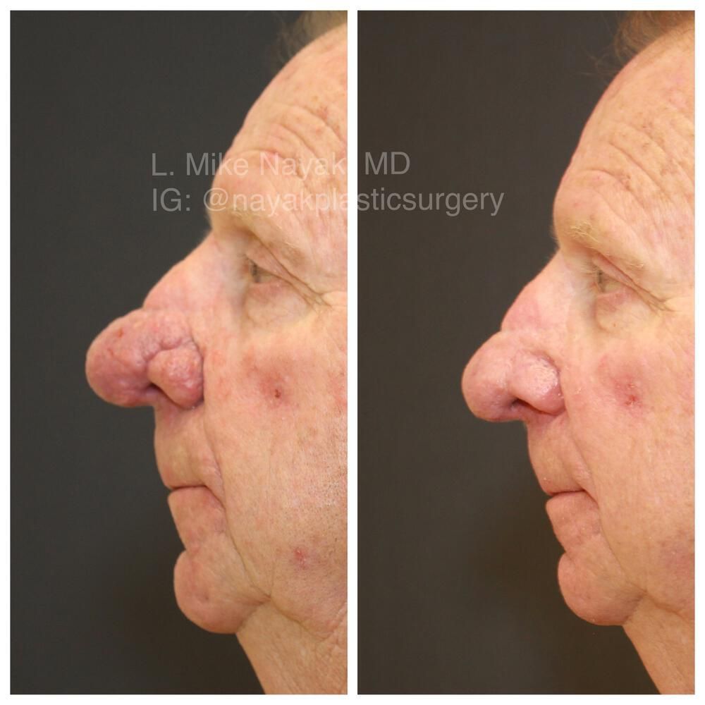 Rhinophyma Reduction Before & After