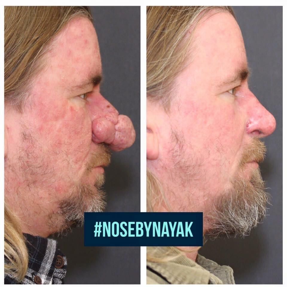Rhinophyma Reduction Before & After