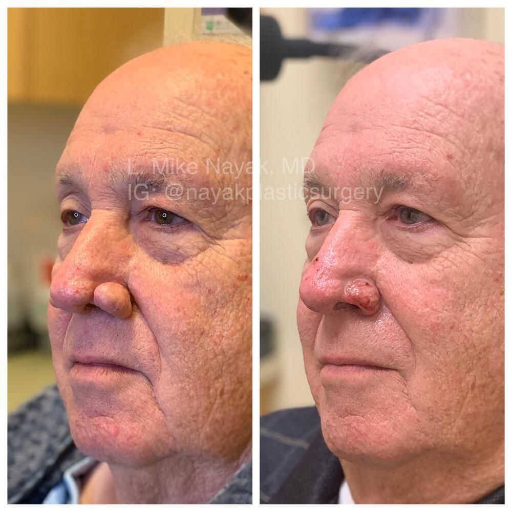 Rhinophyma Reduction Before & After