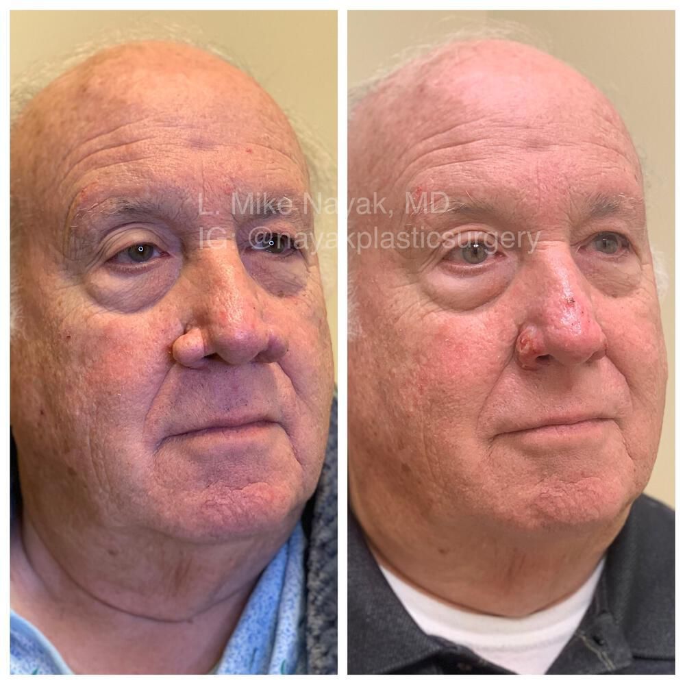 Rhinophyma Reduction Before & After