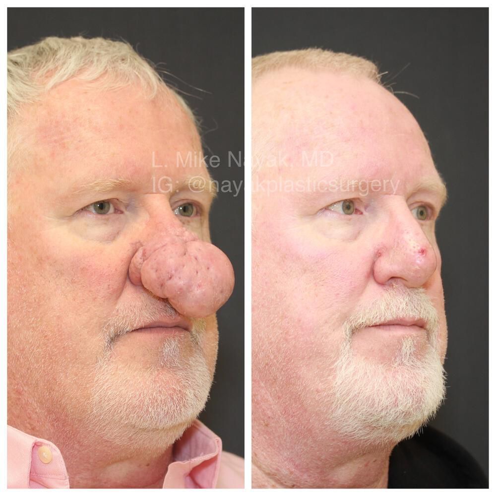 Rhinophyma Reduction Before & After
