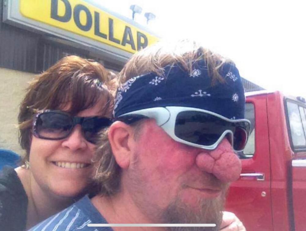 Rhinophyma Reduction Before & After