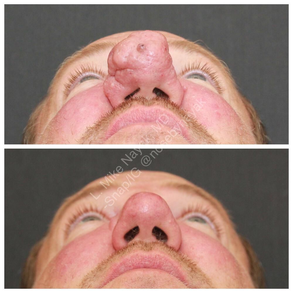 Rhinophyma Reduction Before & After