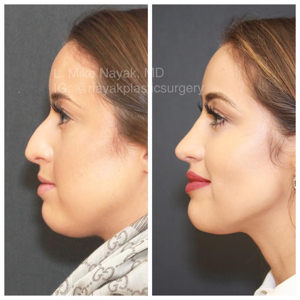 Buccal Fat Removal Before & After