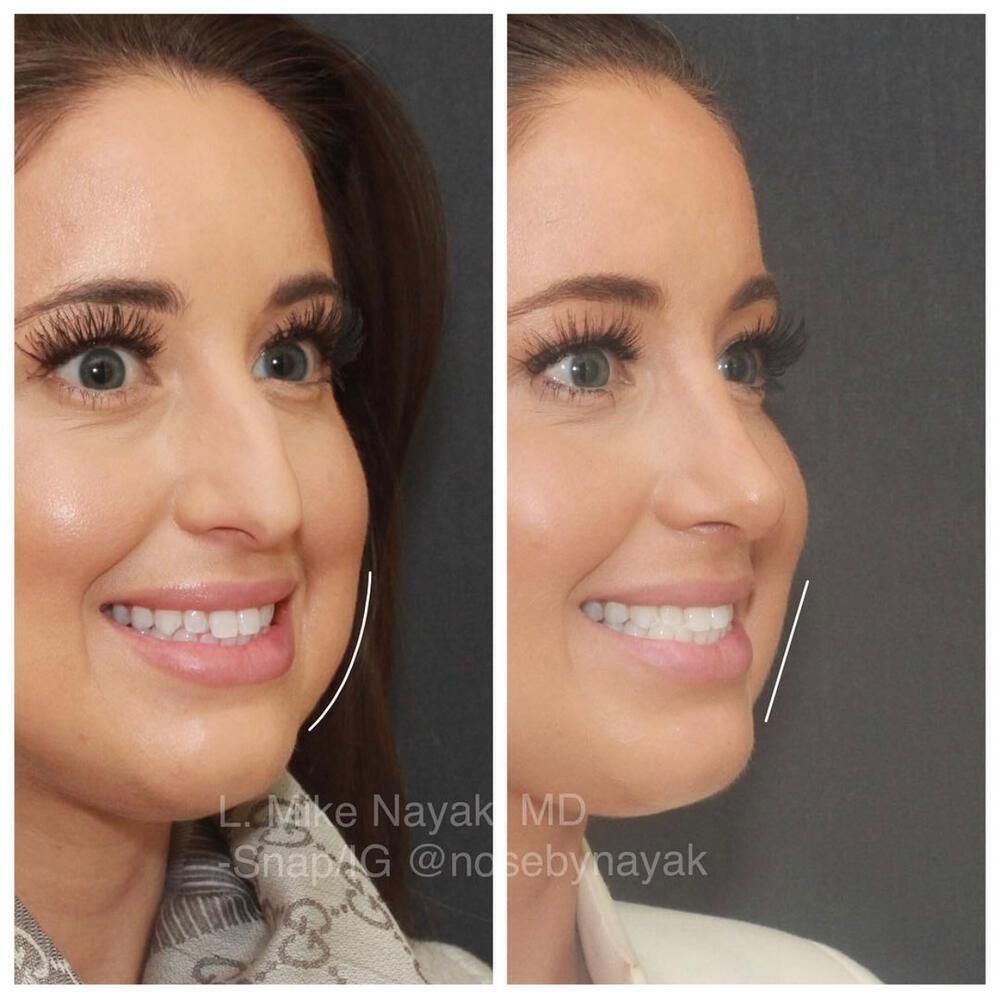 Buccal Fat Removal Before & After