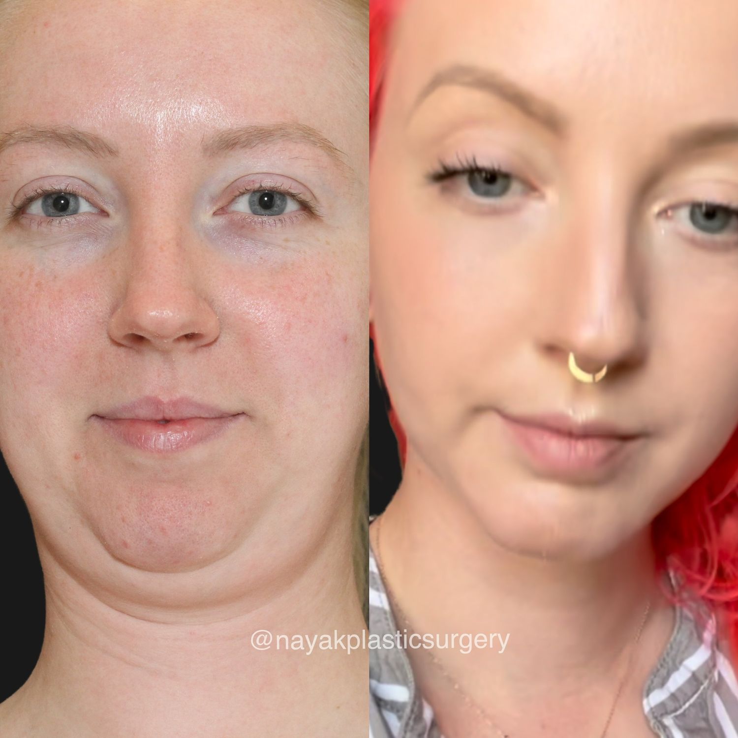 Buccal Fat Removal Before & After