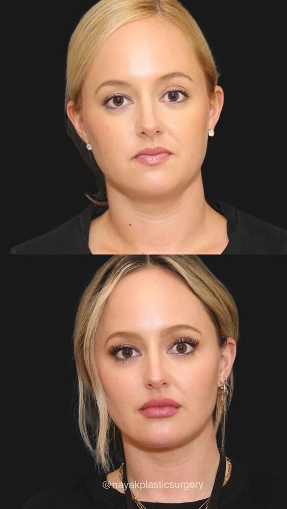 Buccal Fat Removal Before & After