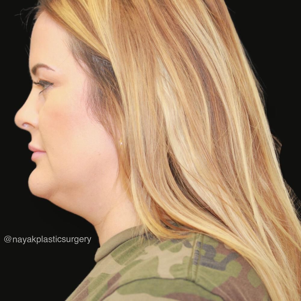 Buccal Fat Removal Before & After