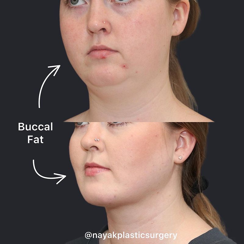 Buccal Fat Removal Before & After