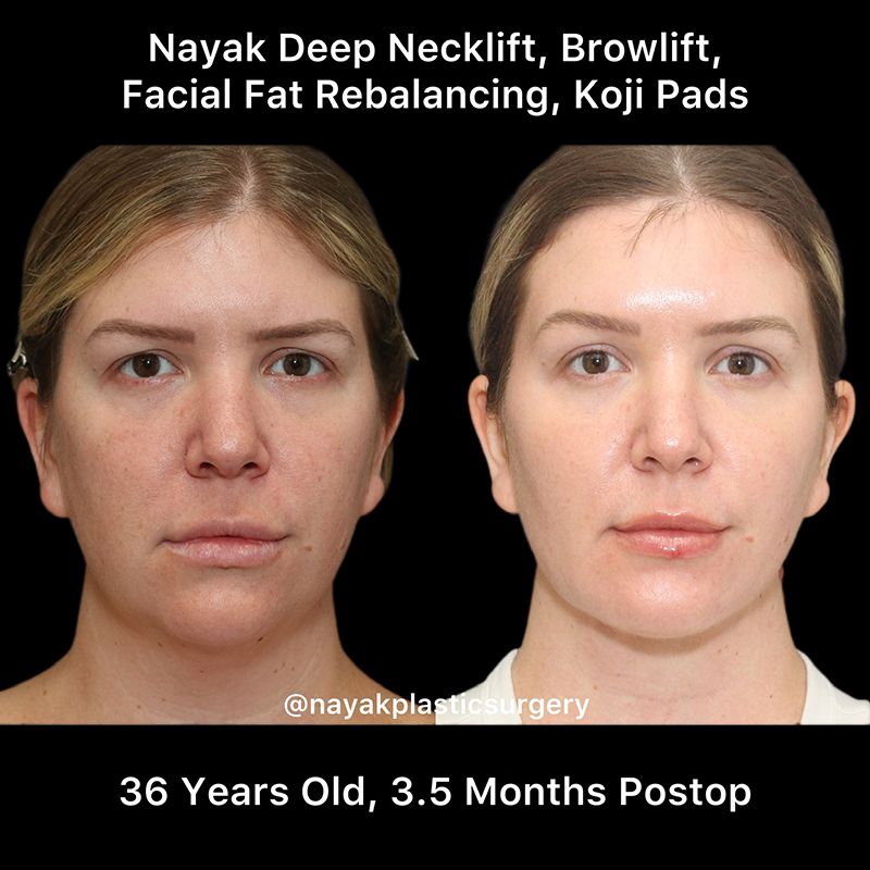 Buccal Fat Removal Before & After