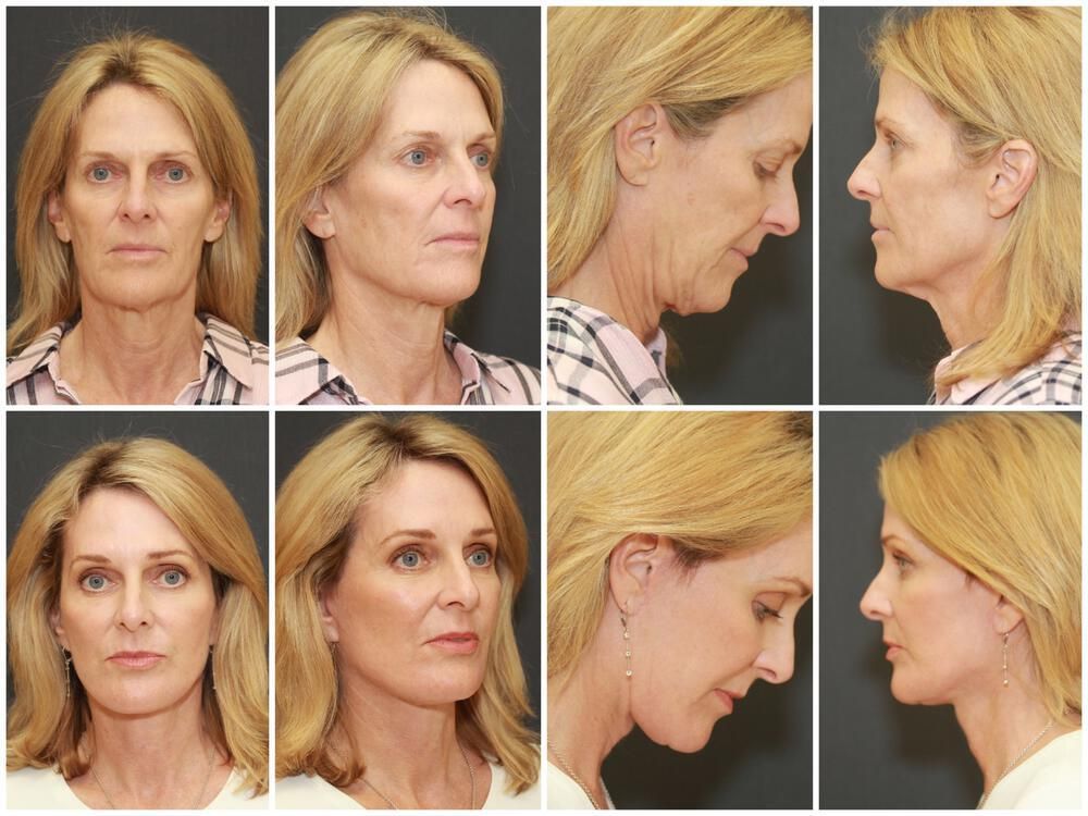 Fat Transfer Before & After