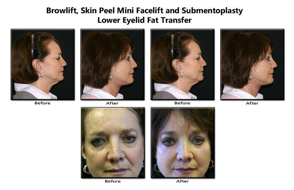 Fat Transfer Before & After