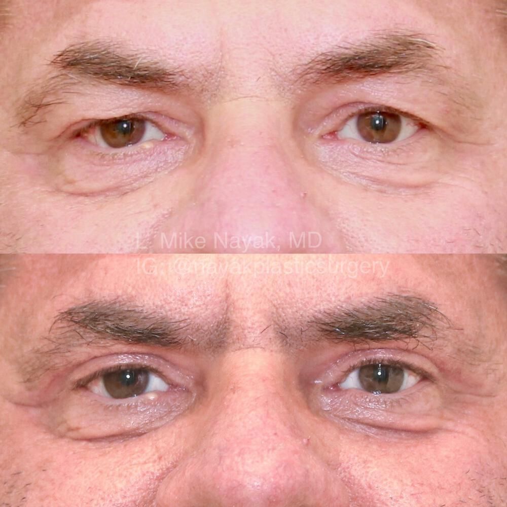 Eyelid Surgery Before & After