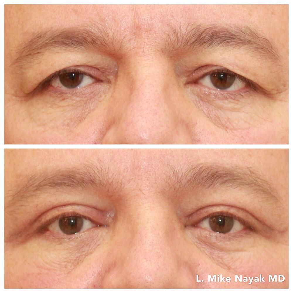 Eyelid Surgery Before & After