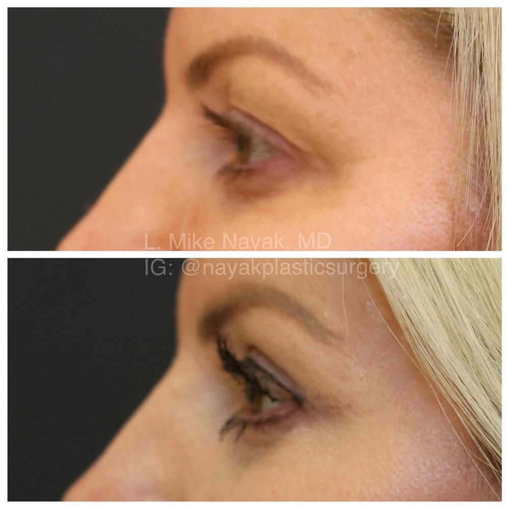 Eyelid Surgery Before & After
