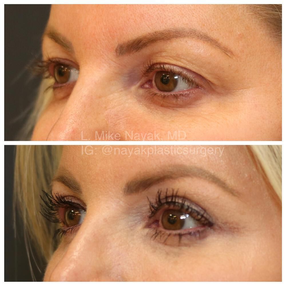 Eyelid Surgery Before & After