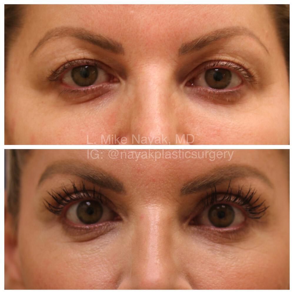 Eyelid Surgery Before & After