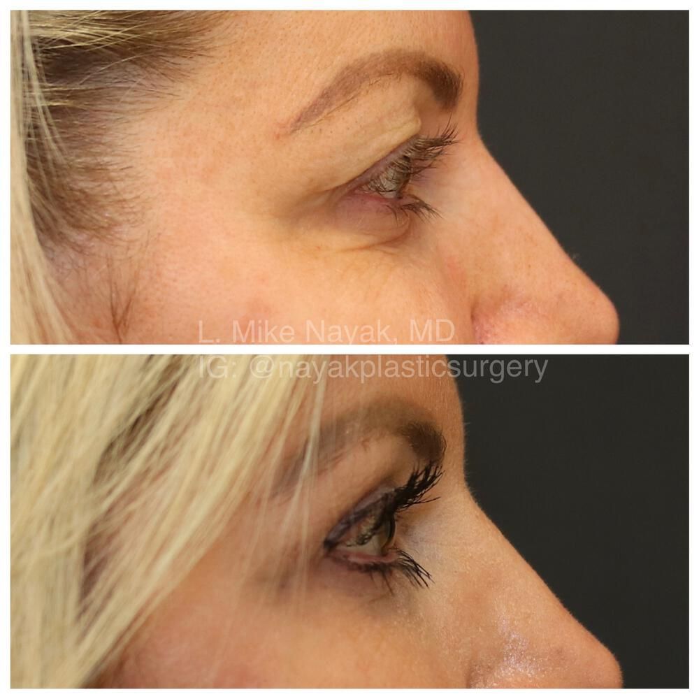 Eyelid Surgery Before & After