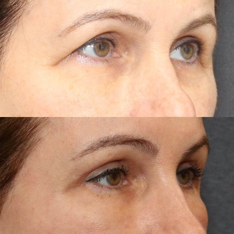 Eyelid Surgery Before & After