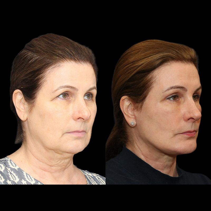 Eyelid Surgery Before & After