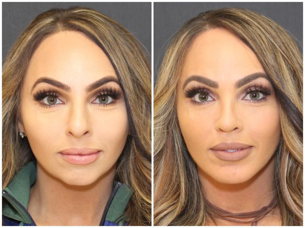 Chin Implant Before & After