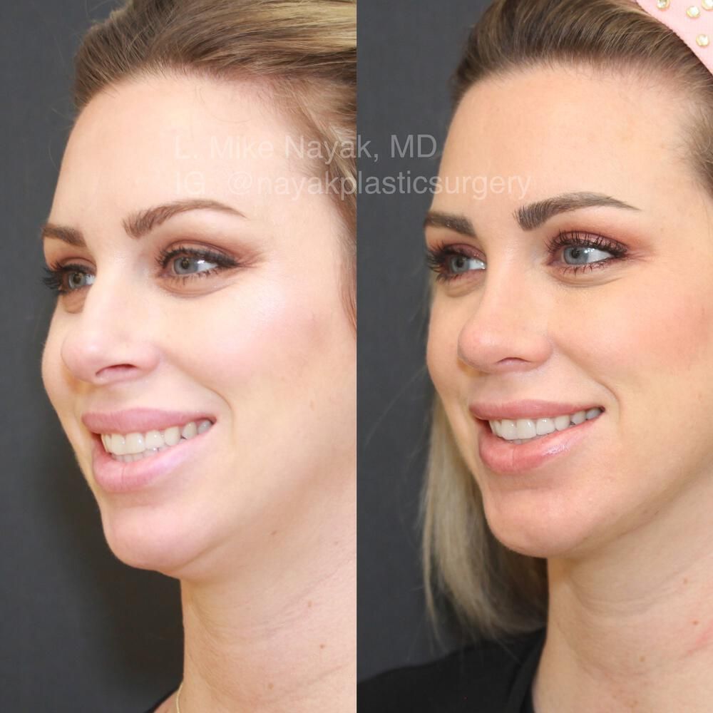 Chin Implant Before & After