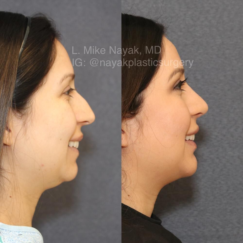 Chin Implant Before & After