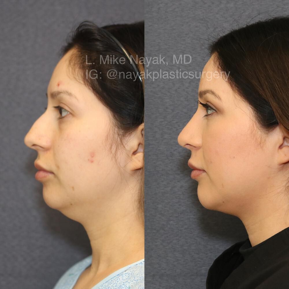 Chin Implant Before & After