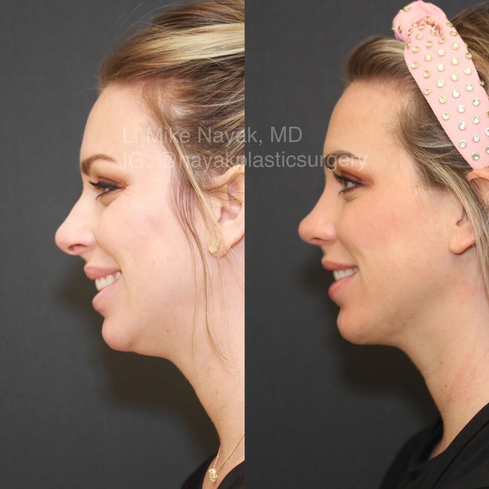 Chin Implant Before & After