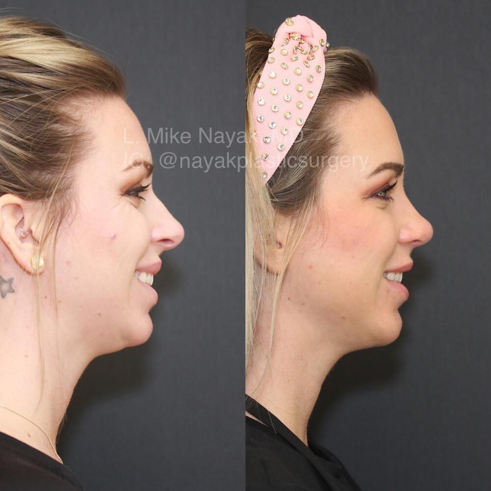 Chin Implant Before & After