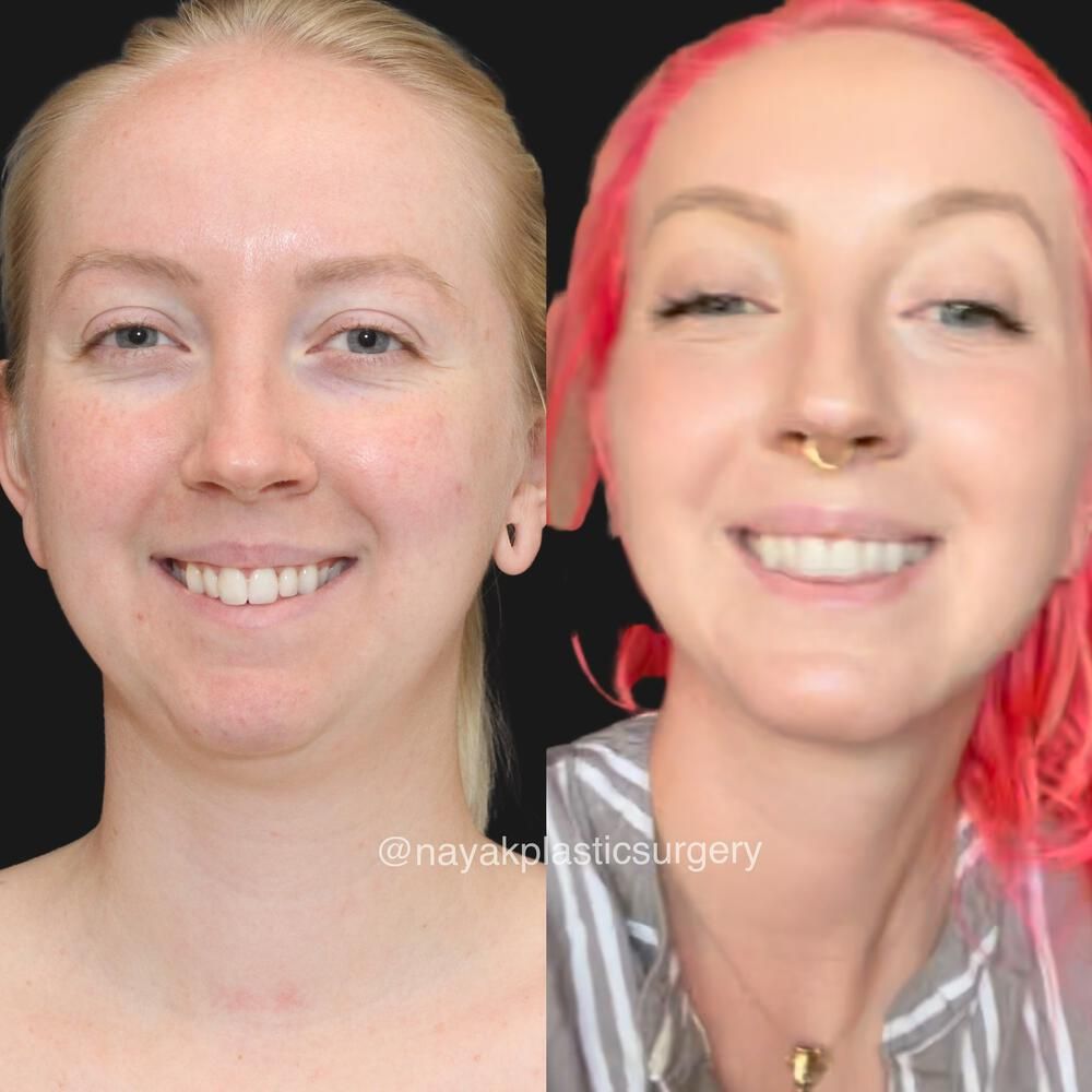Chin Implant Before & After