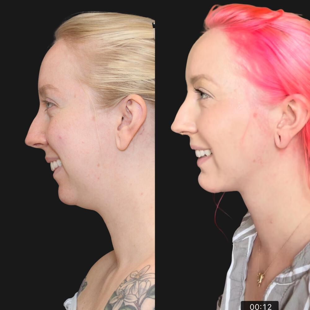 Chin Implant Before & After