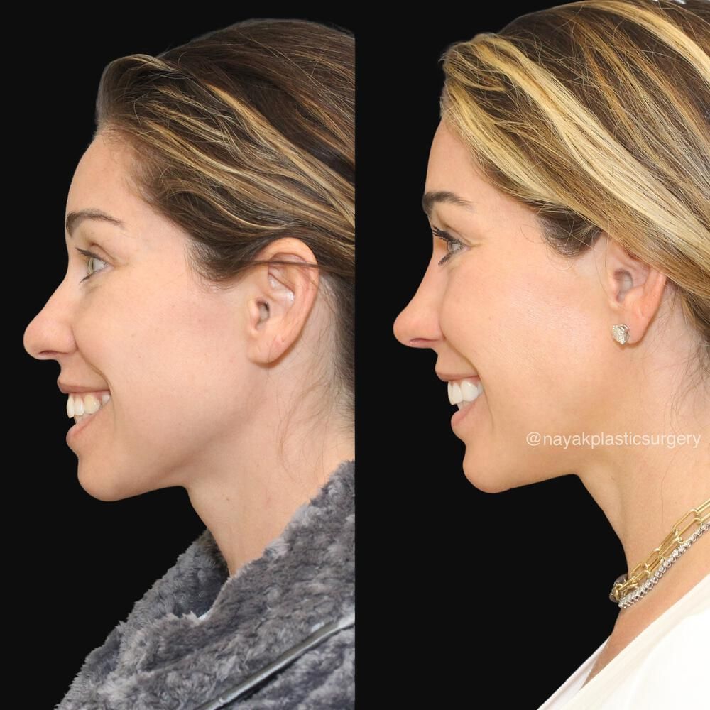 Chin Implant Before & After