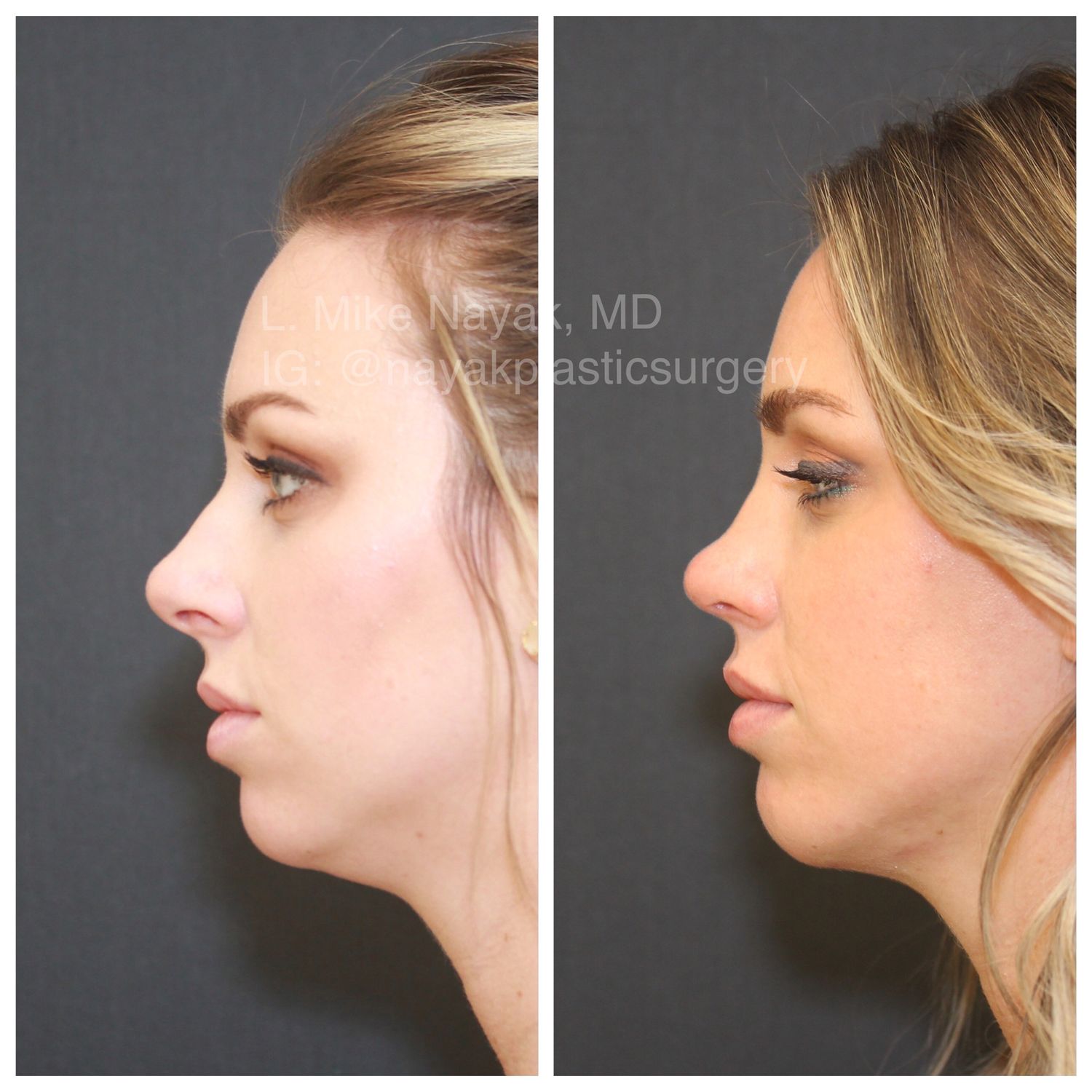 Chin Implant Before & After