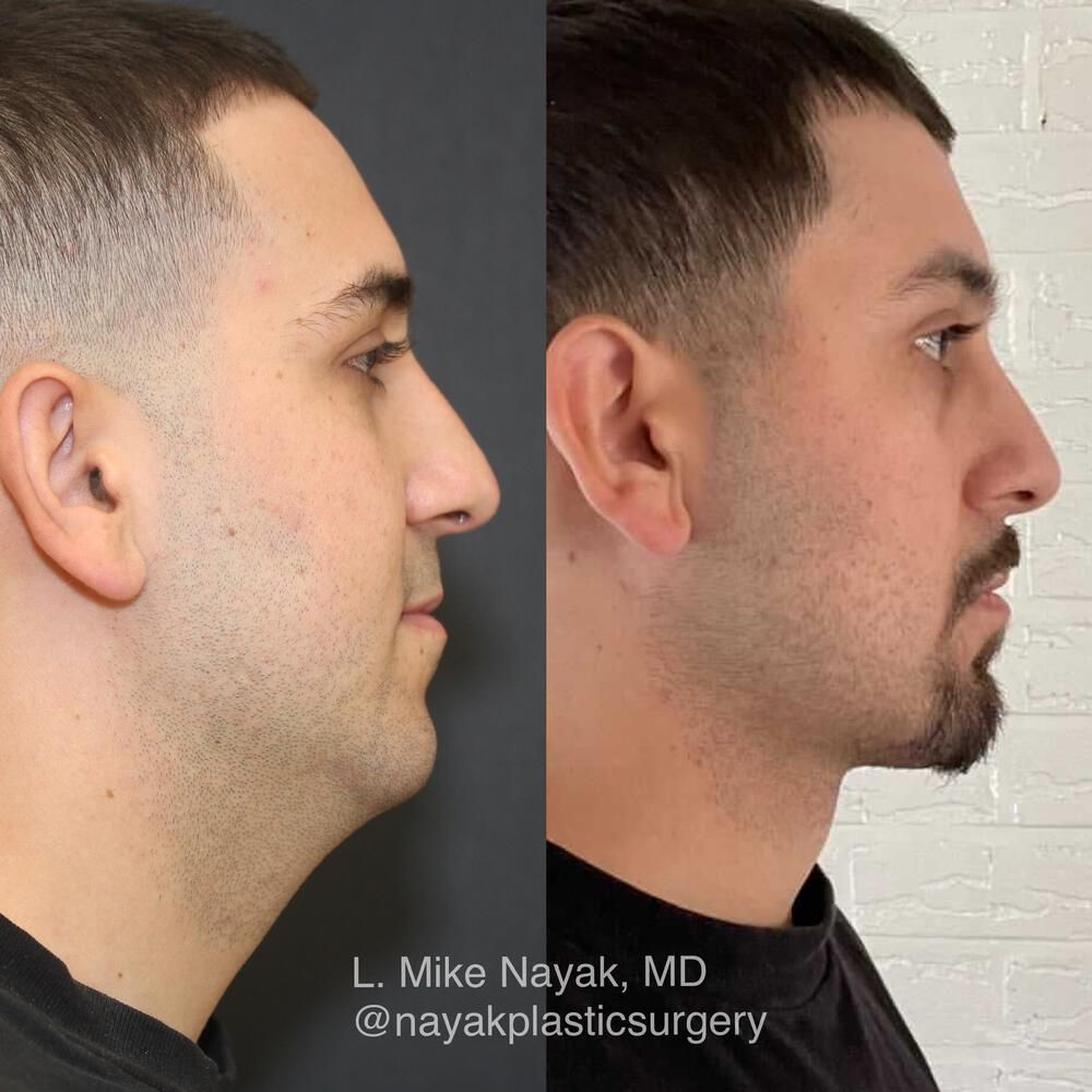 Chin Implant Before & After