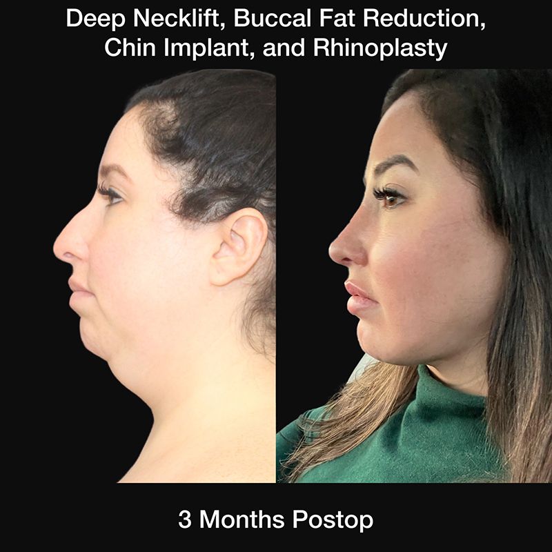 Chin Implant Before & After