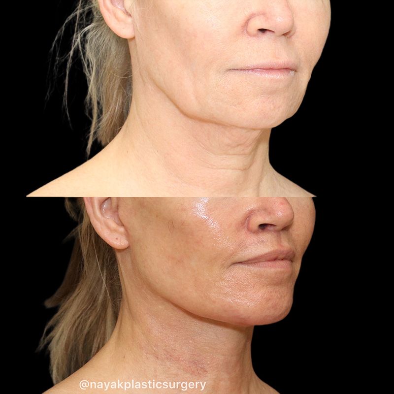 Chin Implant Before & After