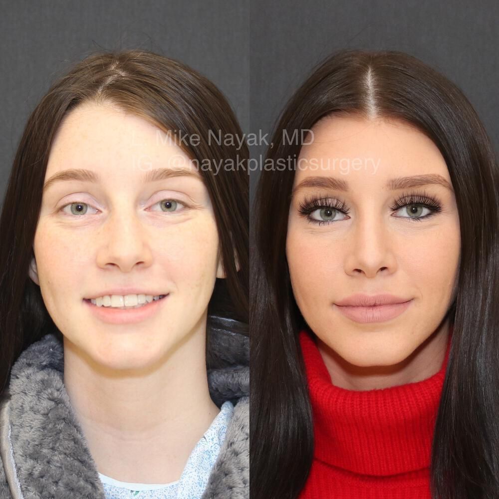 Rhinoplasty Before & After