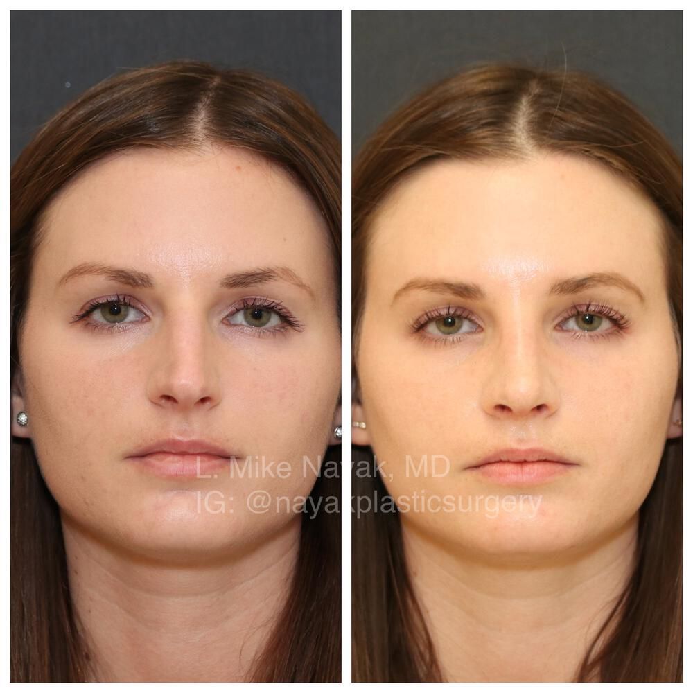 Rhinoplasty Before & After