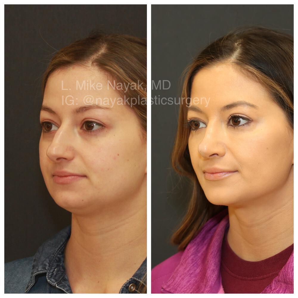 Rhinoplasty Before & After