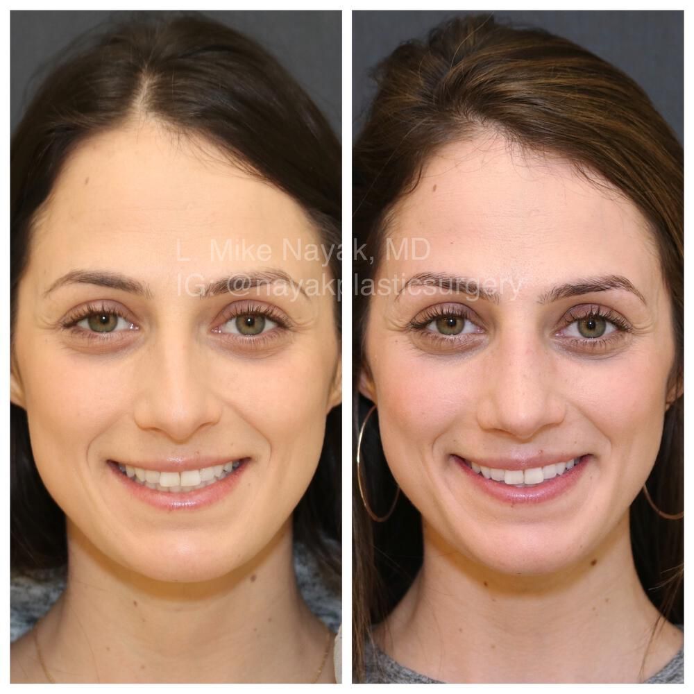 Rhinoplasty Before & After