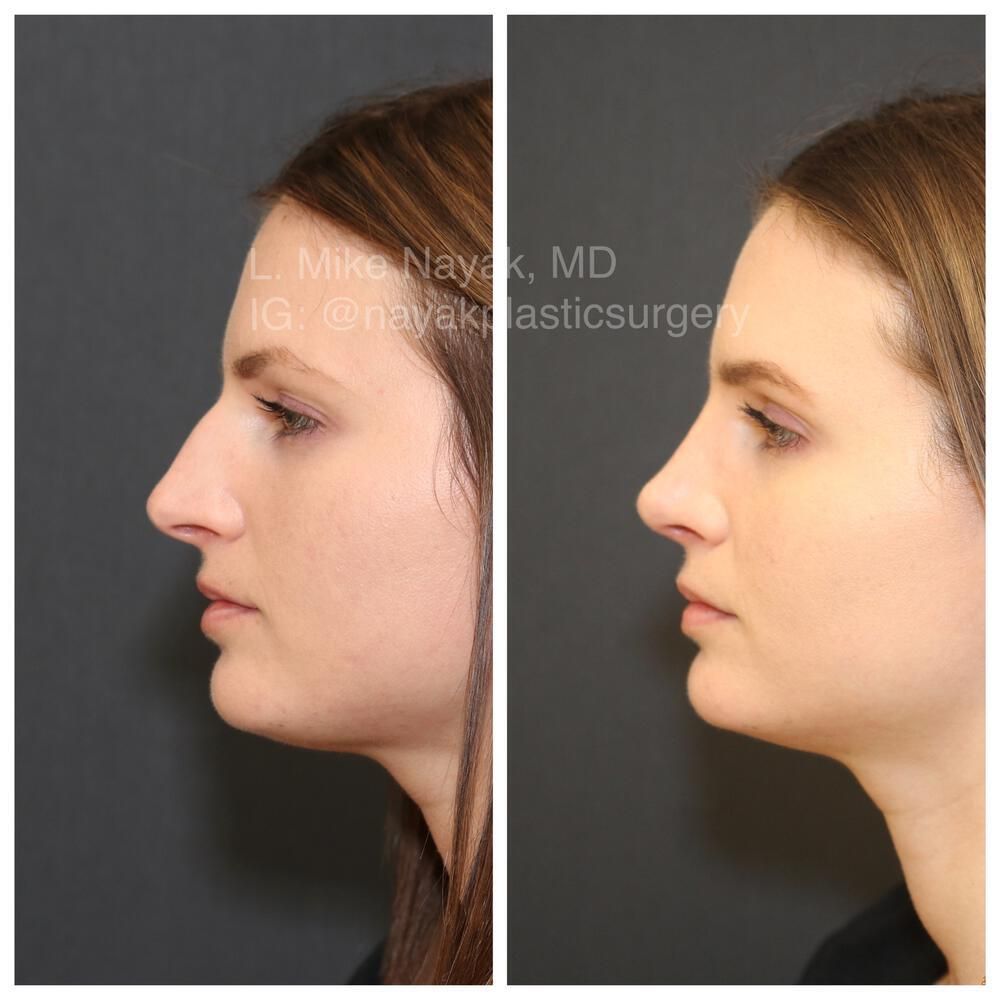 Rhinoplasty Before & After