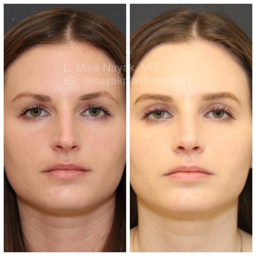 Rhinoplasty Before & After