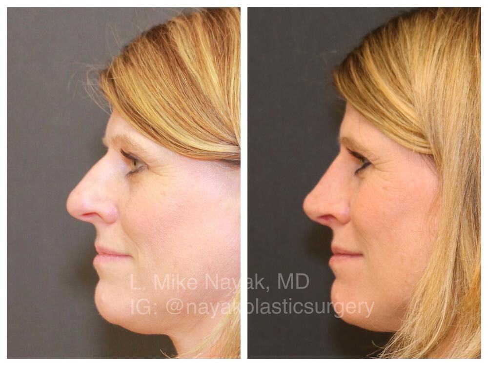 Rhinoplasty Before & After