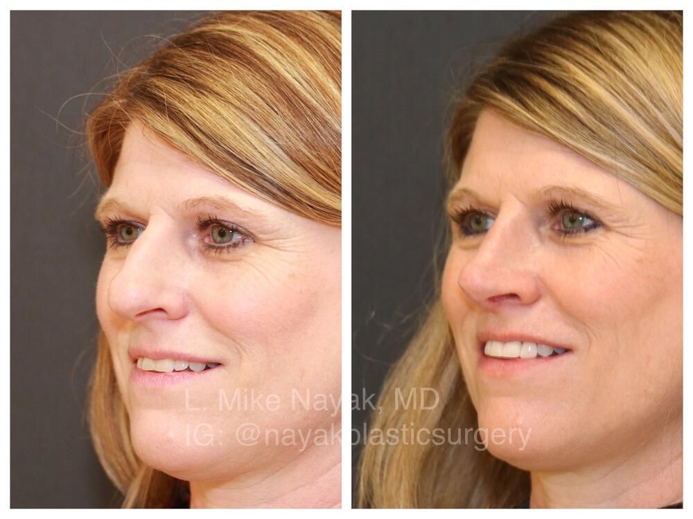 Rhinoplasty Before & After