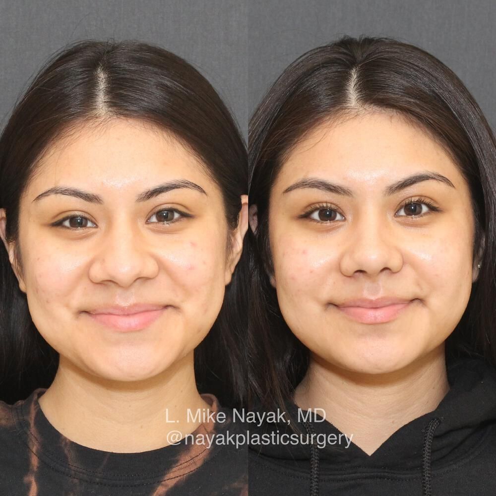 Rhinoplasty Before & After