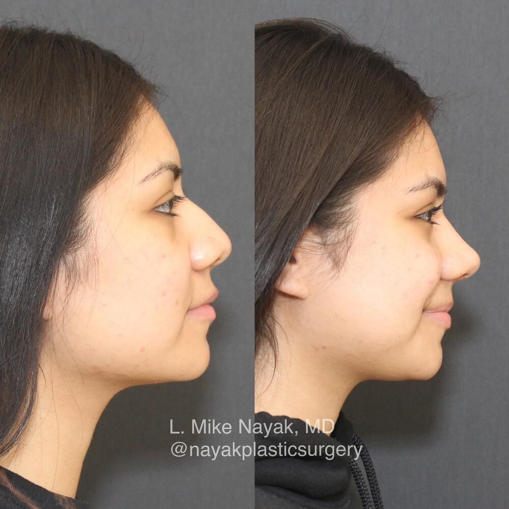 Rhinoplasty Before & After