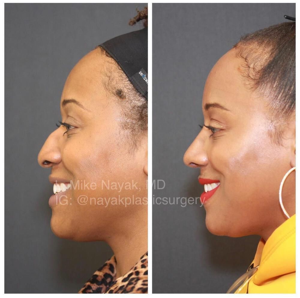 Rhinoplasty Before & After