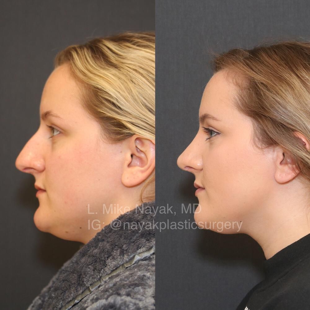 Rhinoplasty Before & After
