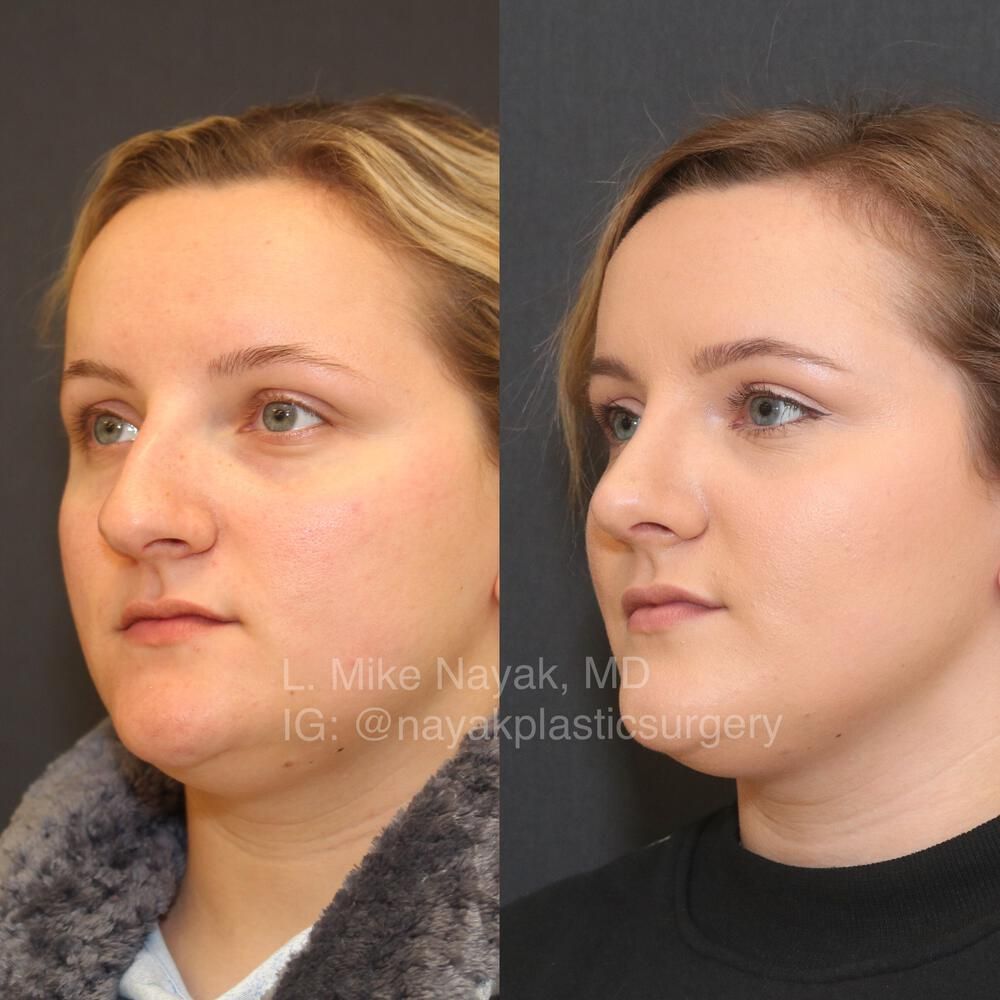Rhinoplasty Before & After